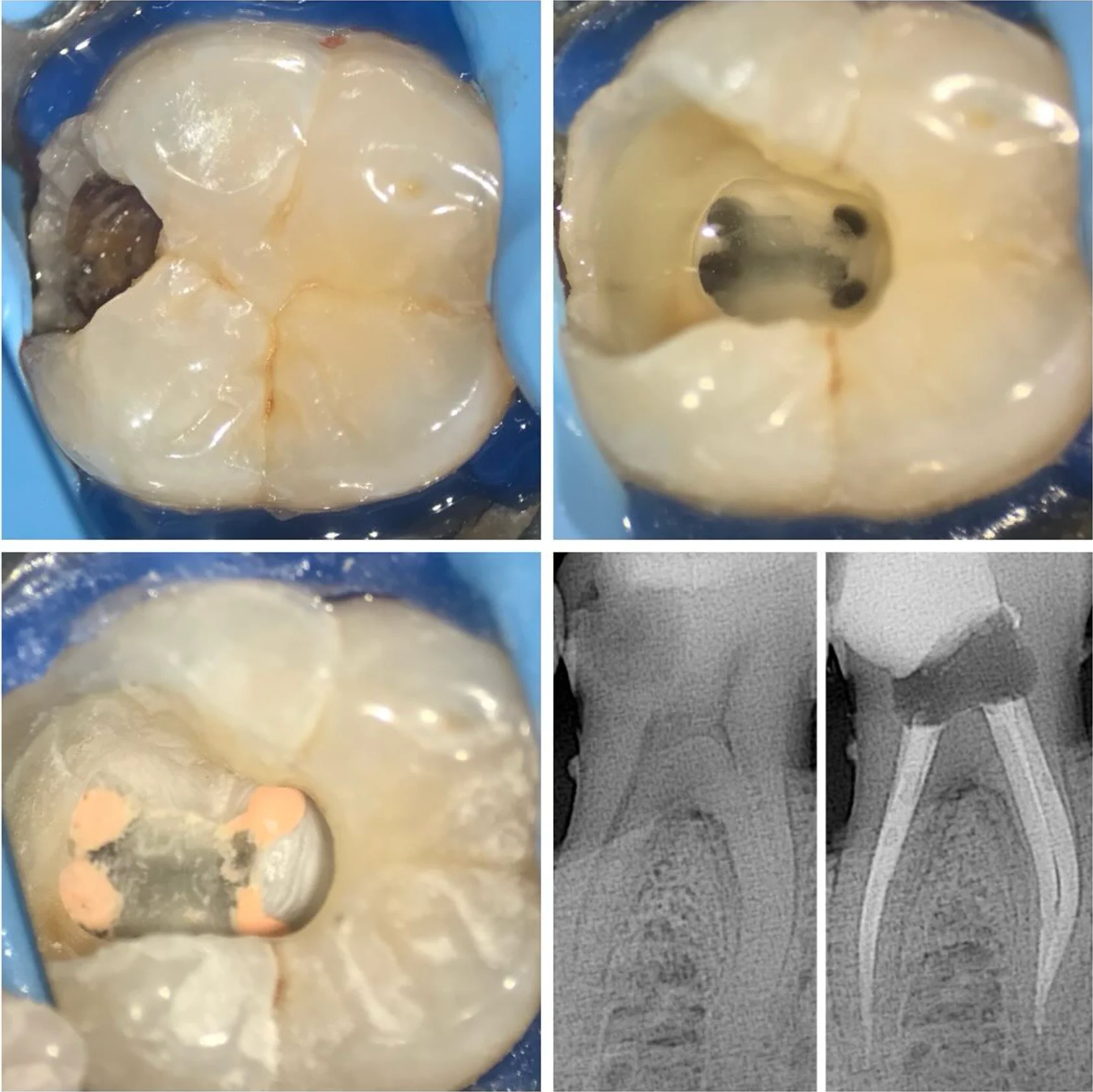 Ankara'da kanal tedavisi öncesi ve sonrası röntgen - başarılı endodontik tedavi örneği