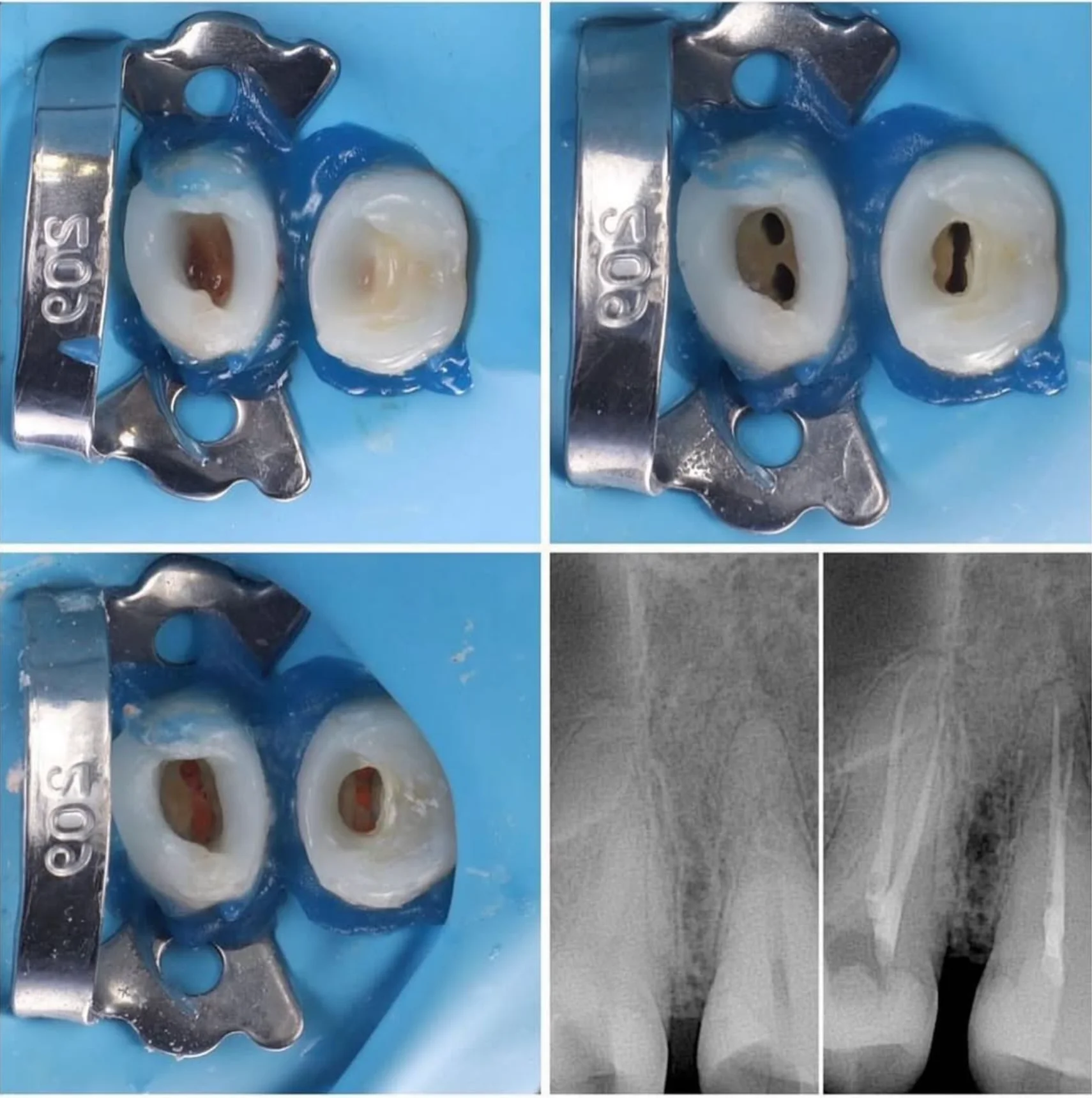 Mikroskobik kanal tedavisi öncesi ve sonrası - endodonti uzmanı tedavi sonucu